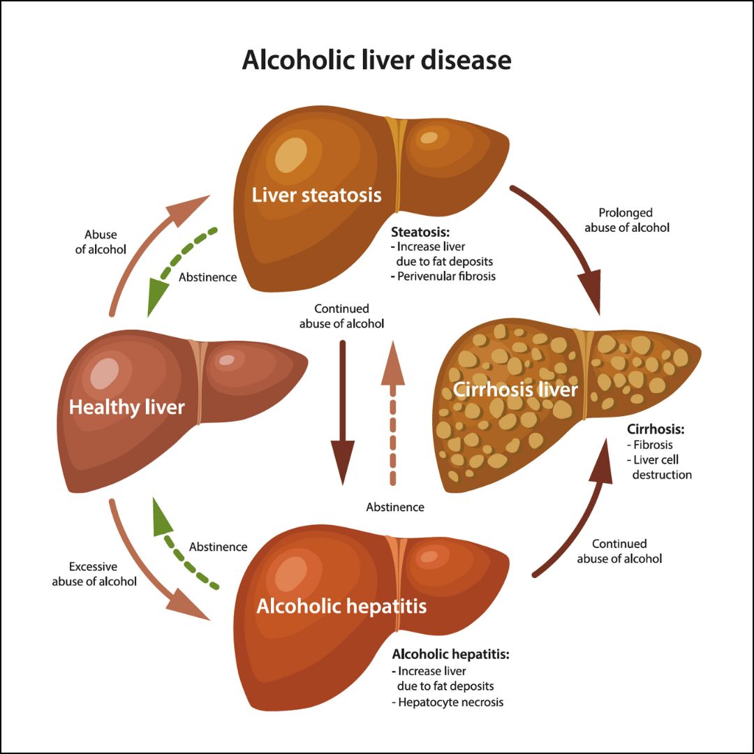 Alcoholic Liver Disease: From Inflammation to Cirrhosis
